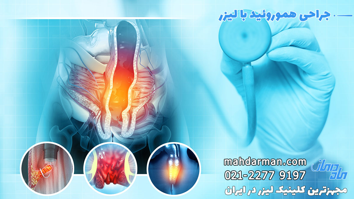 درمان هموروئید با لیزر